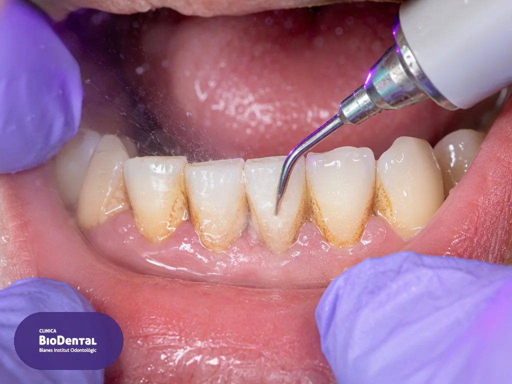 Limpieza dental profesional con ultrasonidos en Blanes: eliminación de sarro y placa bacteriana